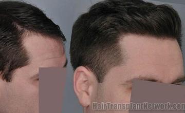 Hair transplantation surgery before and after photos