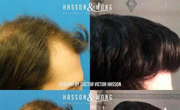 Hair transplantation surgery before and after images