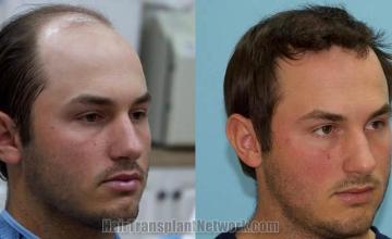 Hair restoration procedure before and after results
