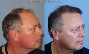 Hair restoration procedure before and after results