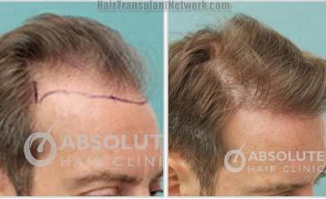 Hair restoration procedure before and after results