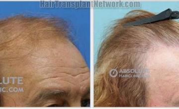 Hair restoration procedure before and after results