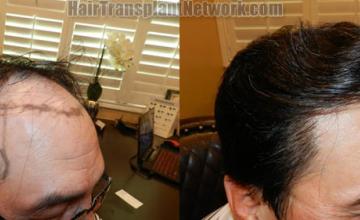  before and after photos