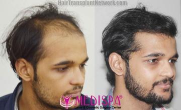 Hair transplantation procedure before and after results