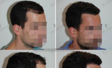 Hair transplantation procedure before and after results