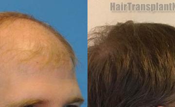 Hair transplantation procedure before and after results