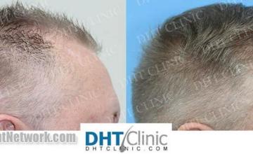 Hair restoration procedure before and after images