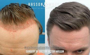 Top view - Before and after hair restoration procedure