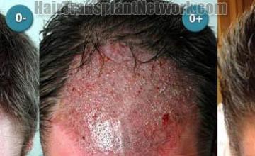 Hair transplantation surgery before and after images