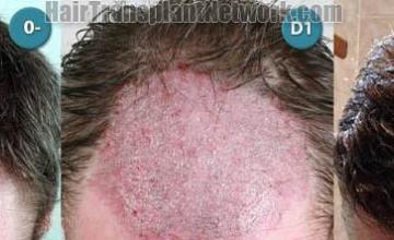 Hair restoration procedure before and after pictures