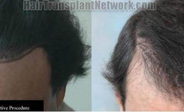 Top view hair restoration procedure repair to correct plugs