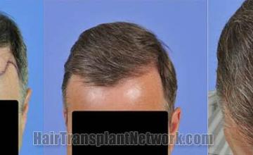 Hair restoration procedure results