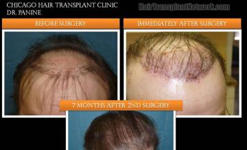 Top view before and after hair restoration results