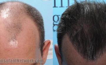 Top view - Before and after surgical hair replacement