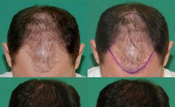 Hair transplantation surgery before and after photos