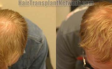 Top view before and after hair restoration results