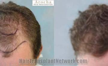 Hair transplantation surgery before and after images