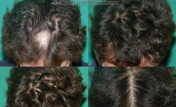 Hair transplantation surgery before and after photos