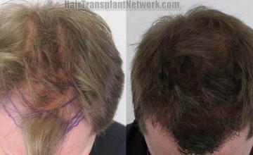 Hair restoration procedure before and after pictures