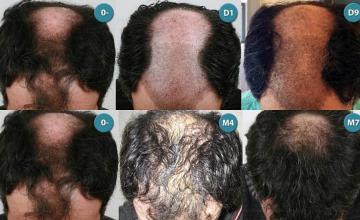 Hair restoration procedure before and after pictures