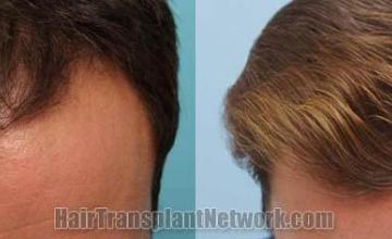 Hair transplantation surgery before and after photos