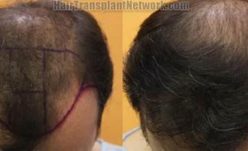 Hair transplantation surgery before and after pictures