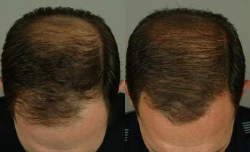 Hair transplantation surgery before and after pictures