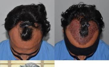 Top view before and after hair restoration results