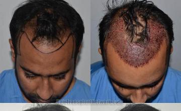 Hair restoration procedure before and after results