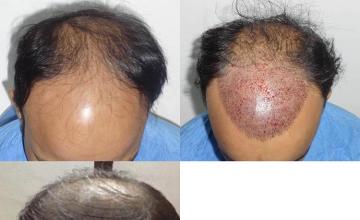 Hair transplantation surgery before and after photos