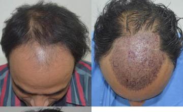 Hair restoration procedure before and after results