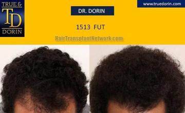 Hair transplantation surgery before and after pictures