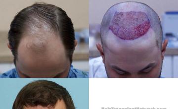 Hair restoration procedure before and after photo results