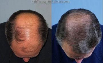 Hair restoration procedure before and after results