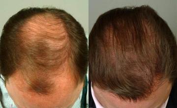 Hair restoration procedure before and after results