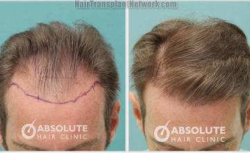 Hair restoration procedure before and after photo results