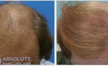 Hair restoration procedure before and after result photos