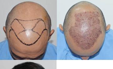 Hair transplantation surgery before and after images