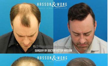 Top view - Before and after hair restoration procedure