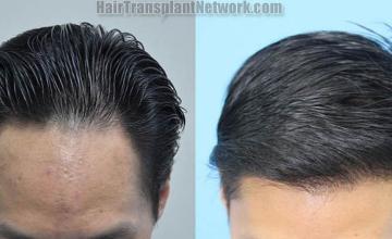 Before and after hair restoration procedure images