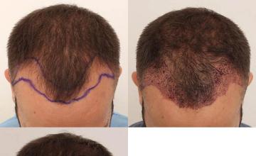 Before and after hair restoration procedure images