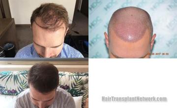 Hair transplantation surgery before and after images