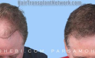 Hair restoration procedure before and after results