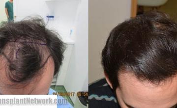 Before and after hair restoration procedure images