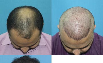 Hair restoration procedure before and after results