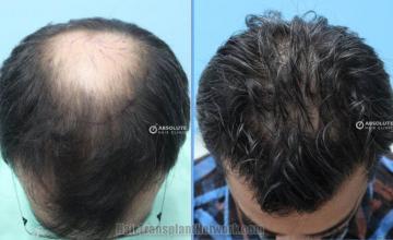 Hair transplantation surgery before and after images