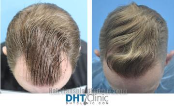 Hair transplantation surgery before and after images