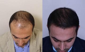 Hair transplantation surgery before and after pictures