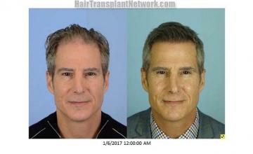 Front view - Before and after hair transplantation surgery