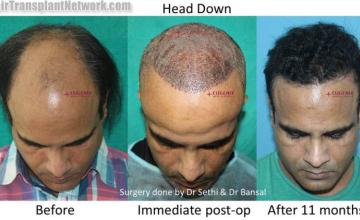 Hair transplantation surgery before and after images